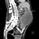 Melanoma, metastases of malignant melanoma in peritoneal cavity: CT - Computed tomography